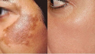 Post Inflammatory Hyperpigmentation PIH